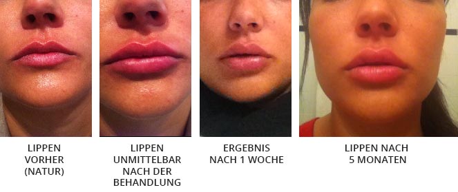 Prozess zu vollen Lippen - lippenaufspritzung